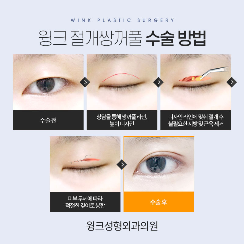 쌍꺼풀 깊은 고정 풀기 관련 이미지 3