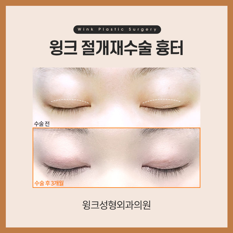 절개쌍꺼풀 절개재수술 흉터도 자연스럽고 깨끗하게! 관련 이미지 5