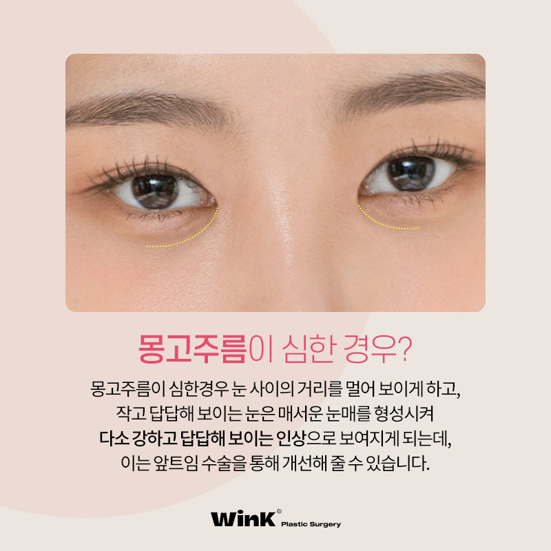 The Impact of Epicanthal Folds on Double Eyelid Surgery! Epicanthoplasty, Epicanthoplasty Cost, Sinsa Epicanthoplasty image 5