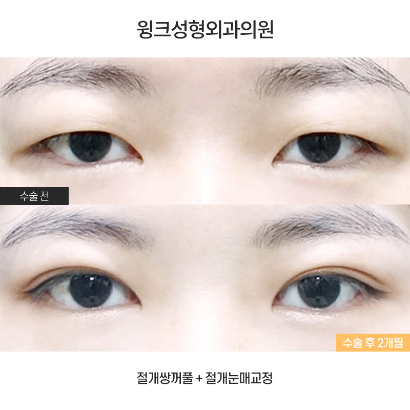 Let’s Learn About Incisional Double Eyelid Surgery. image 1