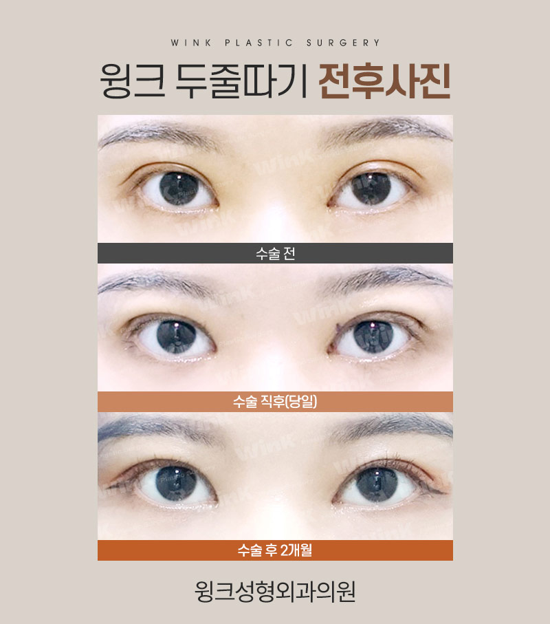 두줄따기로 라인 낮추기 하고 나서 흉터는 어떨까? 관련 이미지 5