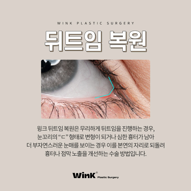 Unnatural eye corners after canthoplasty? Let’s look into canthoplasty revision at Wink Plastic Surgery! image 2