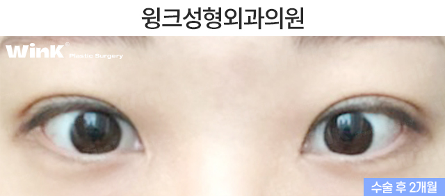 자연유착 쌍꺼풀에 대해 알아보겠습니다. 관련 이미지 6