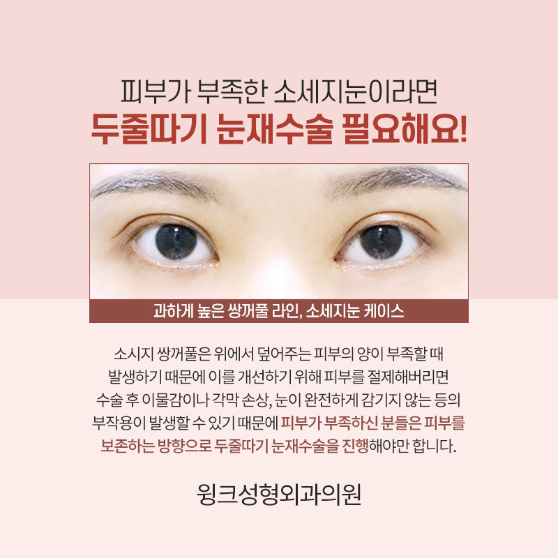 A sausage line can be improved with double-line blepharoplasty revision surgery. image 4