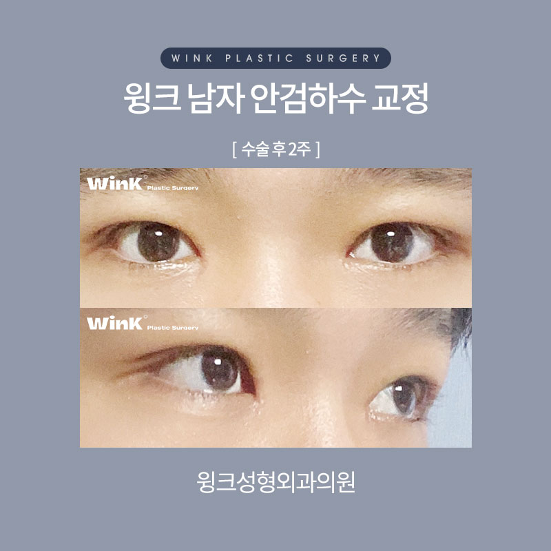남자안검하수 또렷하게 교정하여 시원한 인상으로 개선하는 방법 관련 이미지 5