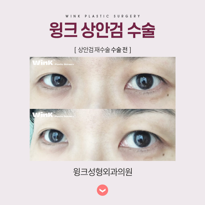 중년눈성형 상안검수술을 알아보자. 관련 이미지 7