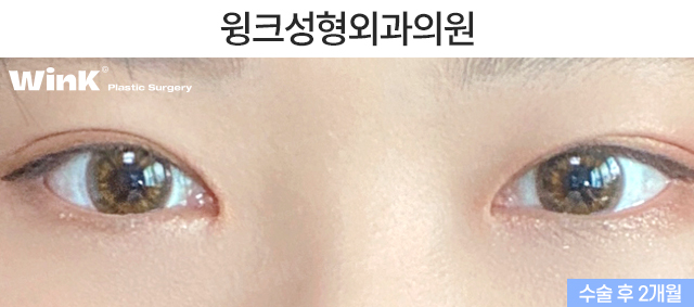 눈매교정의 효과에 대해 알아보겠습니다. 관련 이미지 3