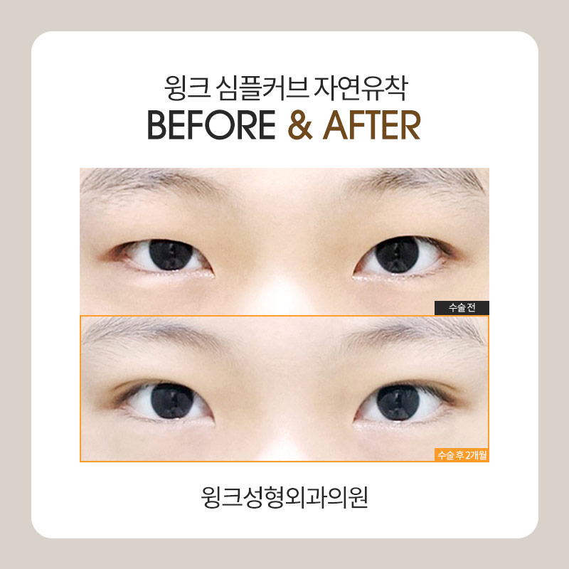 자연유착쌍수후기 자연유착전후를 알아본다면 윙크성형외과가 정답! 관련 이미지 7