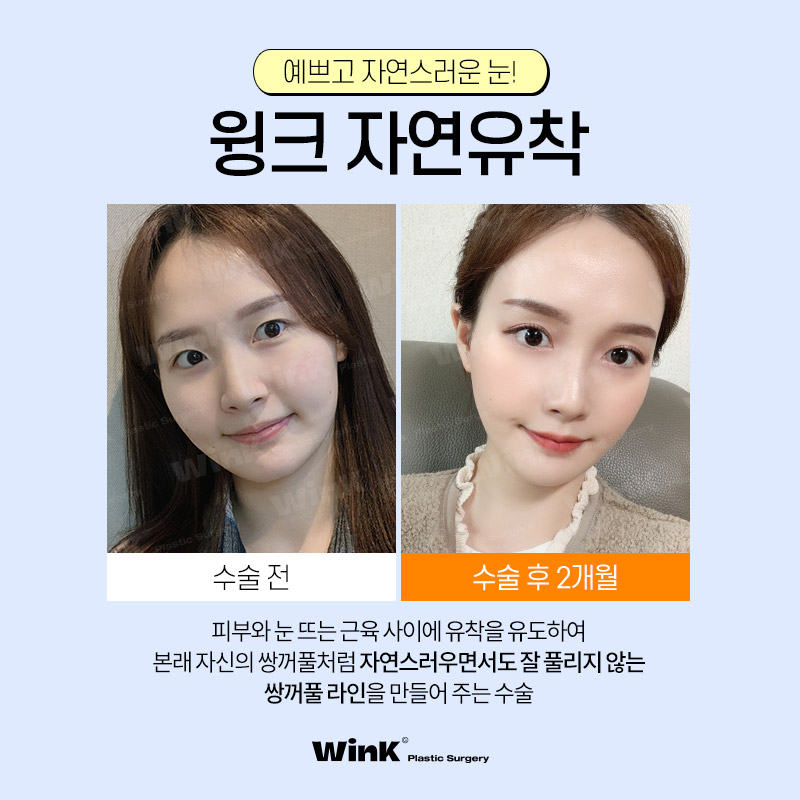 Wink Plastic Surgery’s Natural Adhesion Technique for Naturally Beautiful Eyes That Look Like They’ve Always Been There! image 2