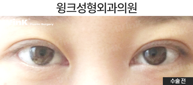 뒷밑트임으로 눈의 숨겨진 공간을 찾자! 윙크 듀얼트임 관련 이미지 5