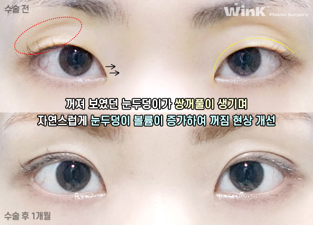 Can I Have My Eyes Surgery Done with Natural Adhesion Too? image 3