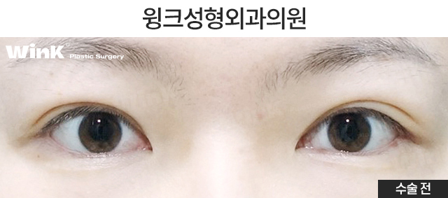 Shall We Learn About Revision Double Eyelid Surgery? image 2