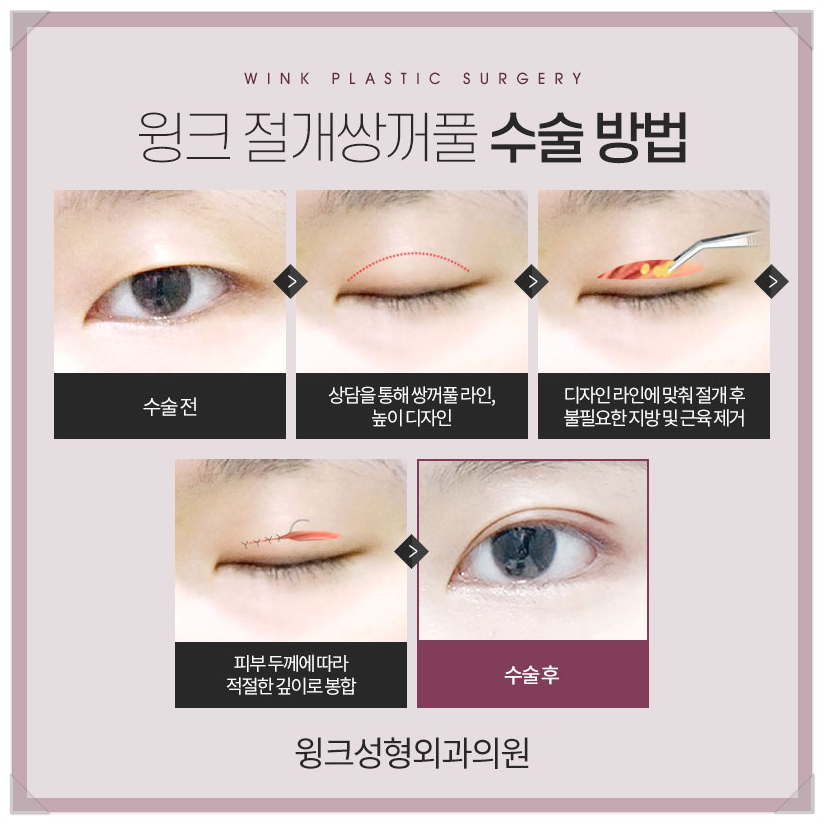 Incisional Double Eyelid Surgery: A Natural Line Without Worrying About Scars Even After Surgery! image 3