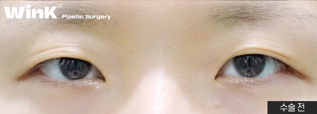 높은 쌍꺼풀 라인, 겹쌍꺼풀과 같은 유형의 눈재수술 방법은? 관련 이미지 9