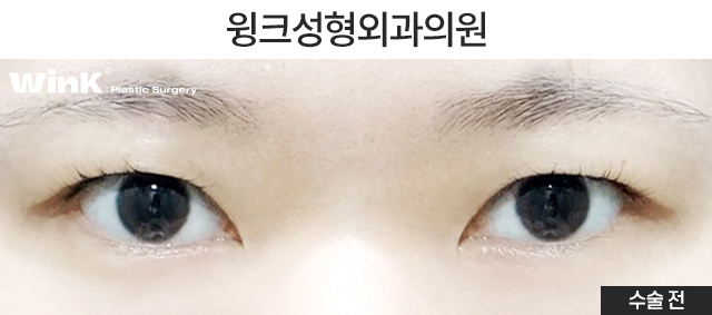 What Are the Important Factors for Successful Revision Eye Surgery? image 2
