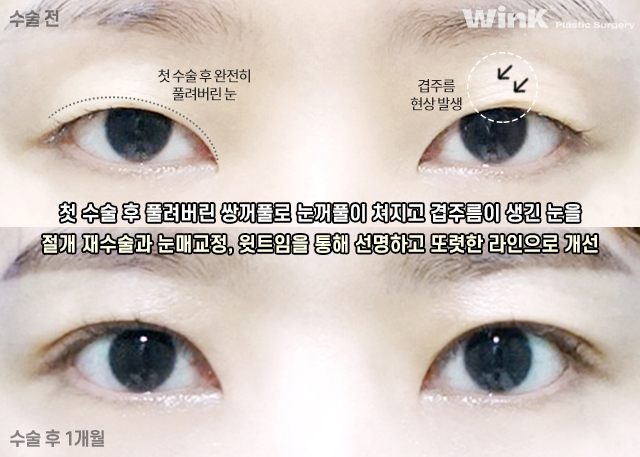 Shall We Take a Look at the Symptoms of Double Eyelid Loosening? image 4