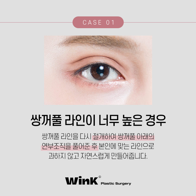 소세지눈재수술 생각한다면? 윙크성형외과 신사역쌍꺼풀재수술 관련 이미지 3