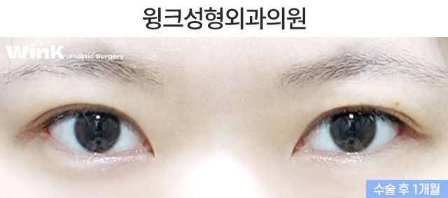 What Are the Important Factors for Successful Revision Eye Surgery? image 3