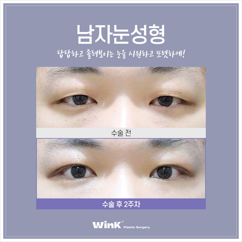 윙크성형외과 남자무쌍수술  남자눈매교정술 남자눈매교정비용 관련 이미지 5