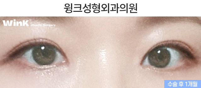 눈매교정의 효과에 대해 알아보겠습니다. 관련 이미지 6