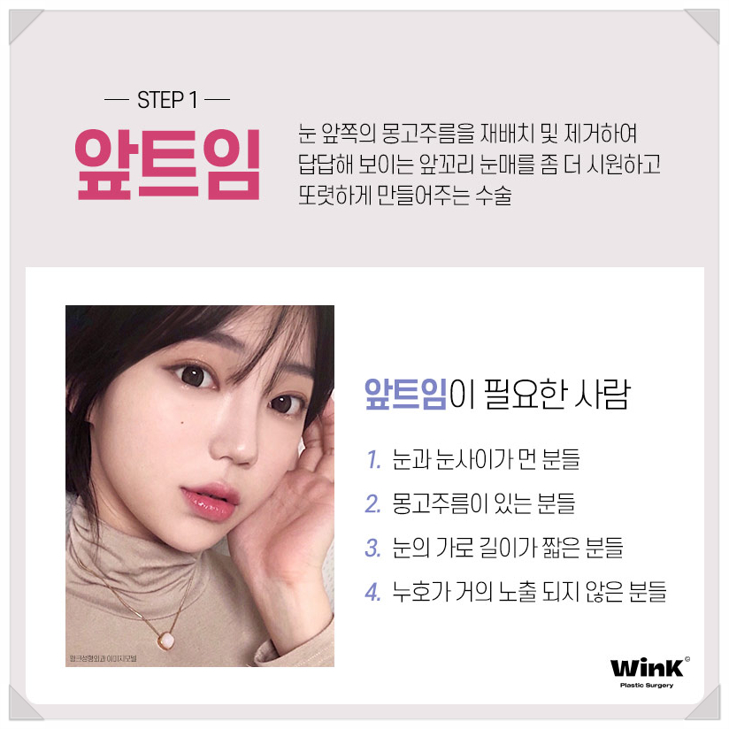 If You’re Looking Into Eye Widening Procedures: Wink Plastic Surgery’s Epicanthoplasty Price, Upper Canthoplasty Before and After, Rear Canthoplasty Reviews, and Where to Get Lower Canthoplasty Well Done image 3