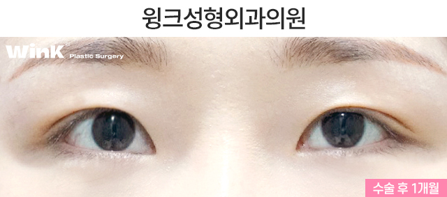Let’s Take a Look at Double Eyelid Surgery for Droopy Eyes. image 3