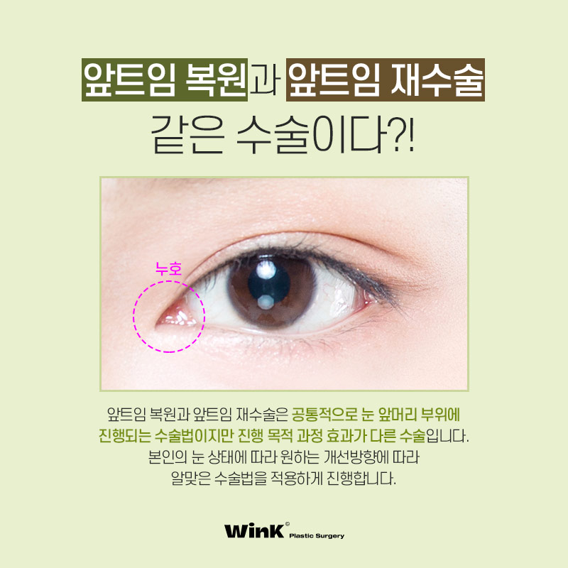 Wink Epicanthoplasty Restoration to Reclose Delicately Opened Inner Eye Corners! image 3