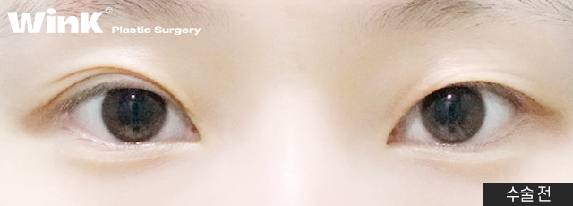 Fast Return to Daily Life and Natural Lines with Wink Natural Adhesion! image 8