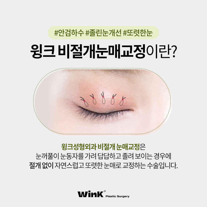 Improvement for Sleepy Eyes? Get Clear, Refreshing Eyes with Non-Incisional Eye Correction at Wink Plastic Surgery! image 4