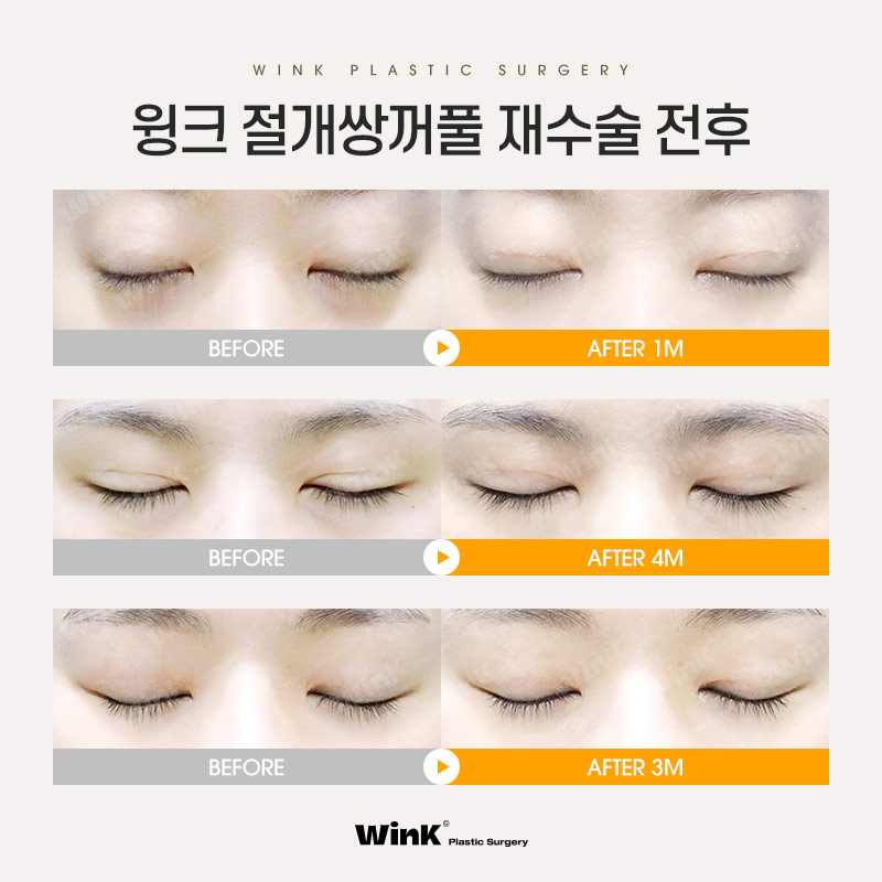 Does double-eyelid surgery with an incision always leave a scar? Revision eyelid surgery scars explained by Wink Plastic Surgery Clinic! image 5