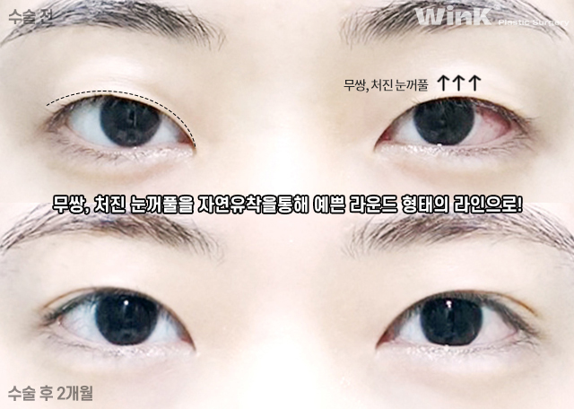 인라인 자연유착 쌍꺼풀 수술에 대해 알아볼까요? 관련 이미지 7