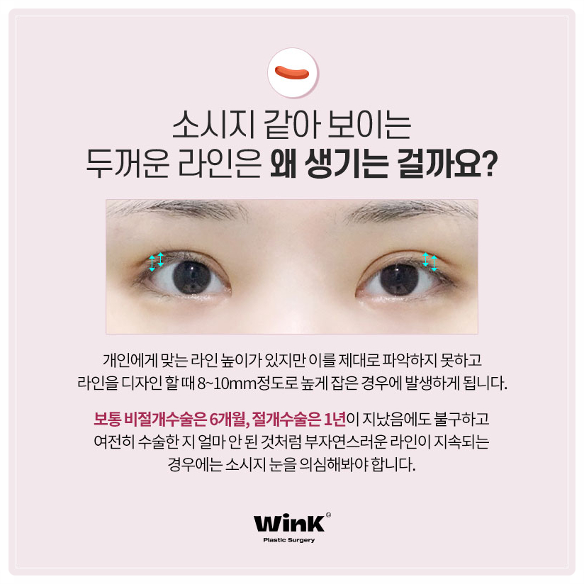 Revision Surgery for Sausage-Like Double Eyelids: Lowering the Double-Eyelid Line, Wink Plastic Surgery Sausage-Eye Revision Review image 2