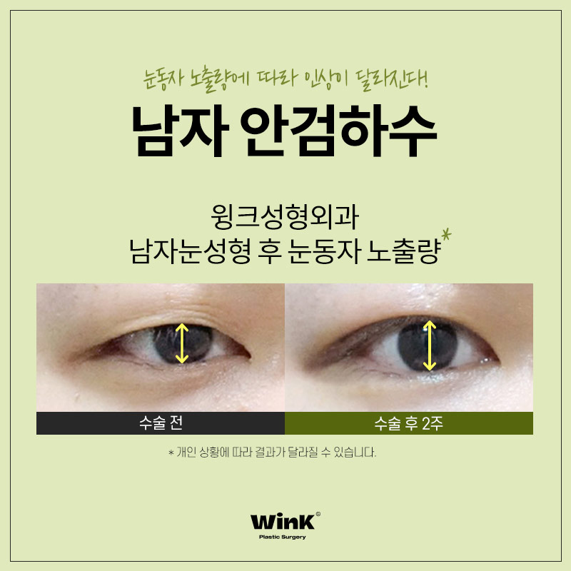 Male Ptosis? Improved Naturally and Unnoticeably at Wink Plastic Surgery! image 6