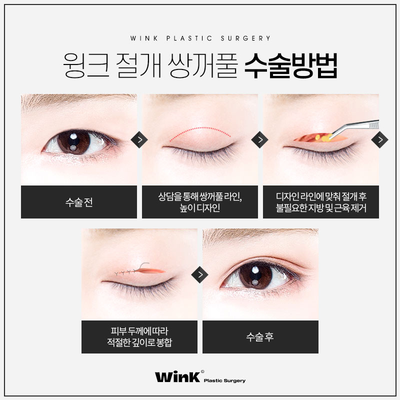 Is Fast Recovery Only Possible with Non-Incisional Surgery? At Wink Plastic Surgery, Incisional Double Eyelid Surgery Can Also Return You to Daily Life Quickly! image 4