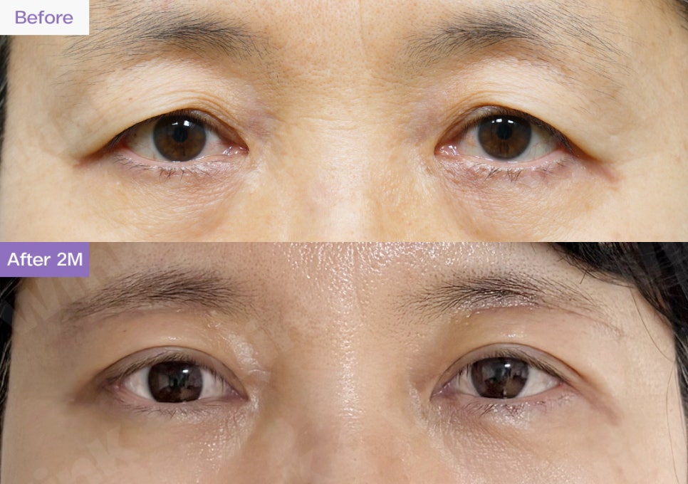 Upper Blepharoplasty or Sub-Brow Lift? Which Procedure Is Suitable for Middle-Aged Eye Plastic Surgery? image 4