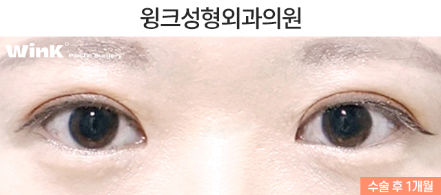 두줄따기 절개 눈재수술로 소세지눈에서 벗어나 볼까요? 관련 이미지 3