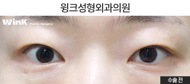 윗트임은 어떤 경우에 하면 좋을까요? 관련 이미지 2