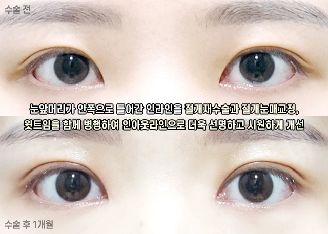 Shall We Learn About Revision Double Eyelid Surgery? image 7