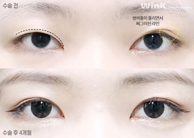통통한 쌍꺼풀과 겹주름, 해결 방법은? 관련 이미지 4