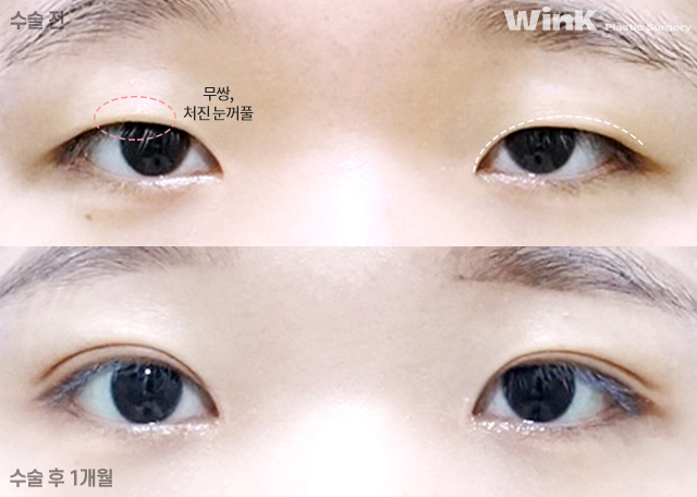 Should We Leave Eyelid Tape and Eyelid Glue Behind with Natural Adhesion Double Eyelid Surgery? image 4
