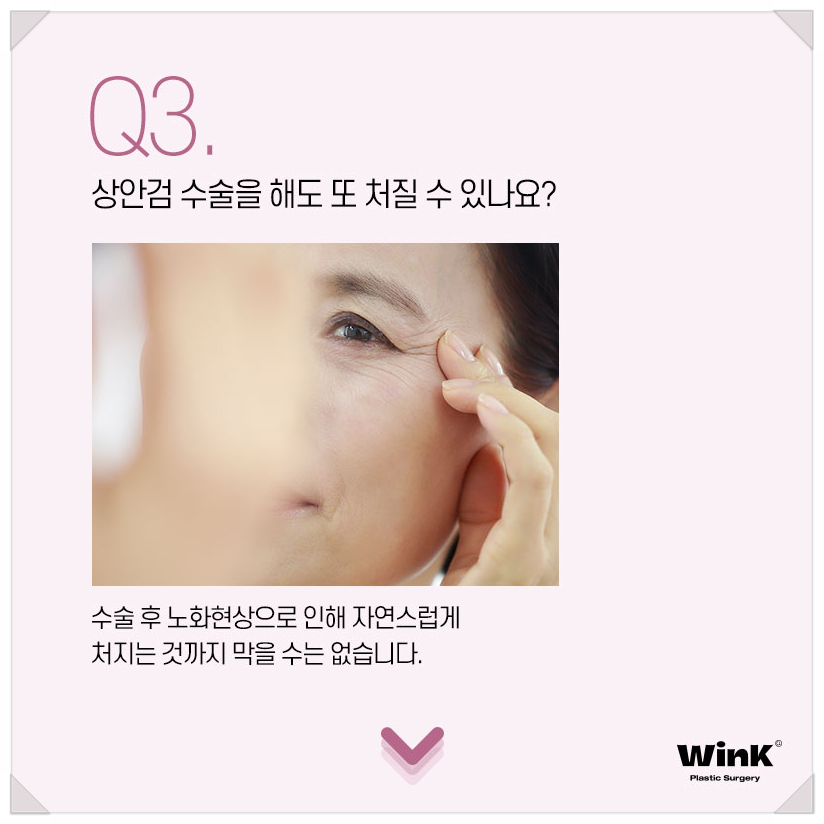 처진눈꺼풀수술 눈처짐수술 알아본다면 윙크성형외과 상안검수술 상안검수술회복기간 관련 이미지 6