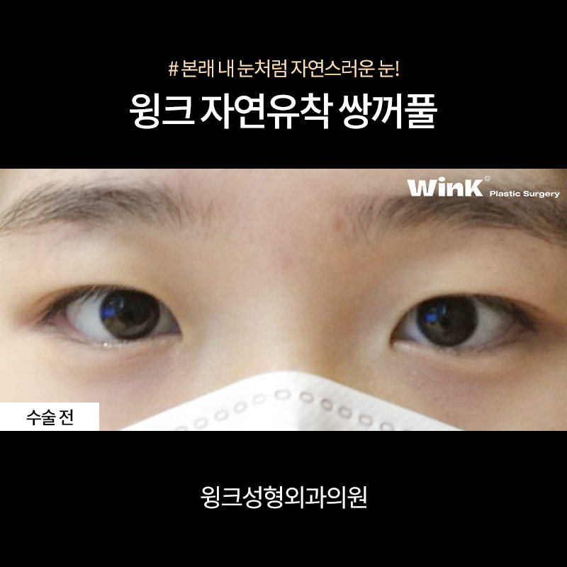 Double-Eyelid Stitching, WINK Plastic Surgery Natural Adhesion image 3