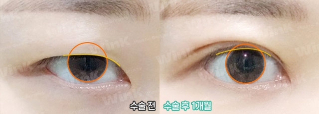적절한 눈동자 노출로 더욱더 또렷한 눈매로! 관련 이미지 10