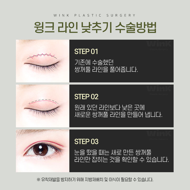 부담스러운 소세지눈? 윙크성형외과 두줄따기 쌍꺼풀 라인낮추기로 호감형 이미지로! 관련 이미지 3