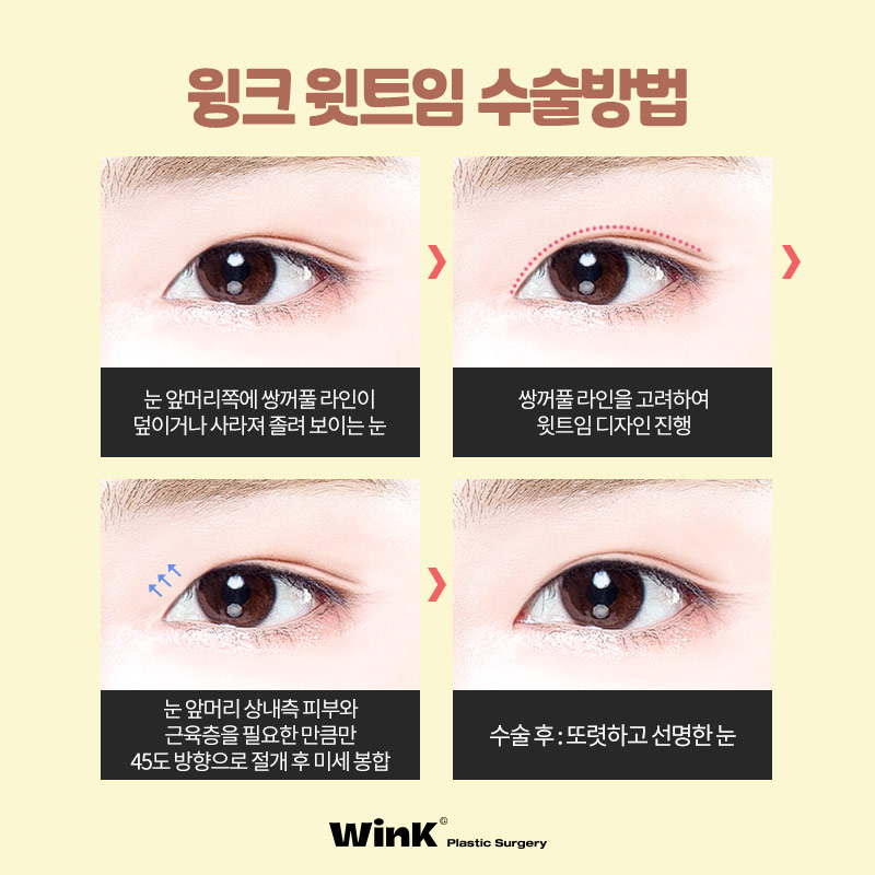 섬세하게 들어올려 또렷한 윙크윗트임 윗트임후기 윗트임잘하는곳 신사윗트임가격 관련 이미지 5