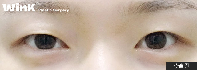 Non-incisional Eye Correction Review: A Natural, Clear Eye Shape! image 6