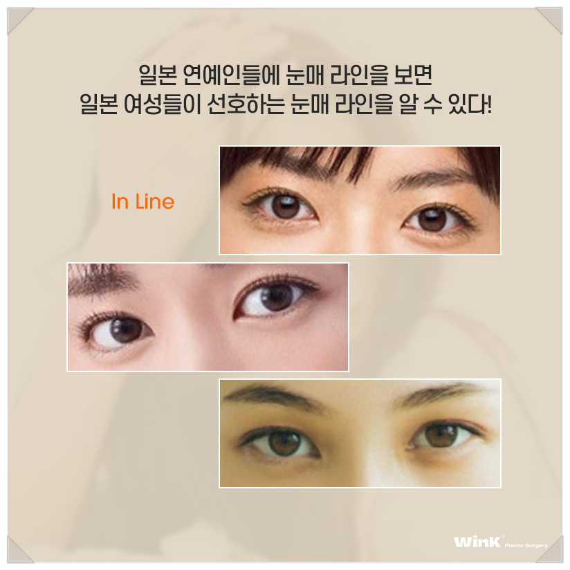 Japanese Double Eyelid Line? In-line Celebrity, Out-line Celebrity, and Wink Sinsa Natural Adhesion Double Eyelid Surgery image 5