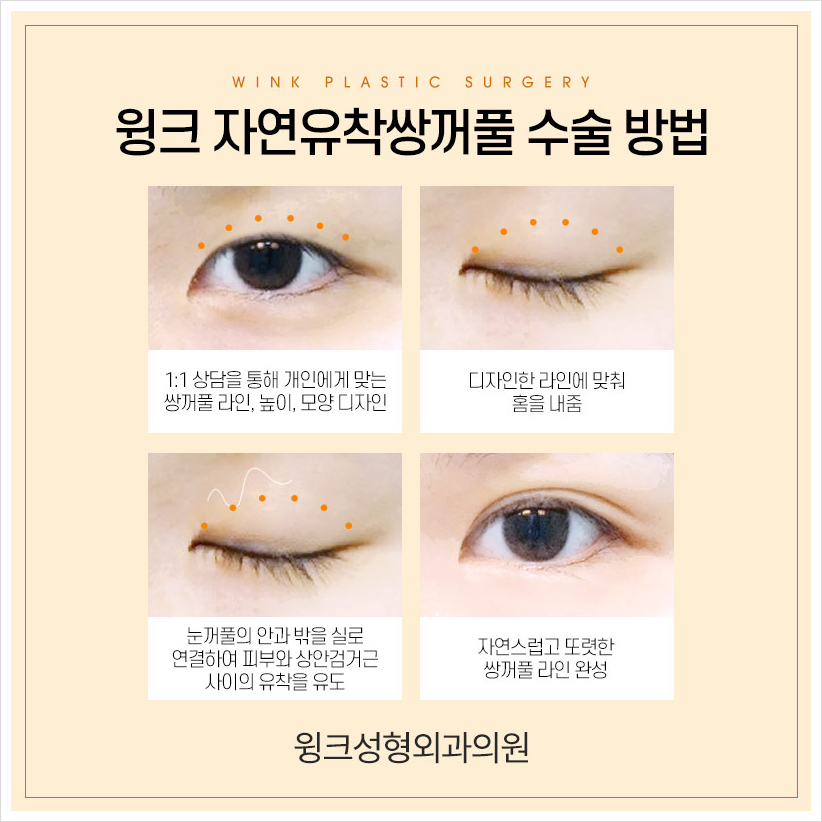 인라인쌍꺼풀 윙크성형외과 자연유착쌍꺼풀후기 자연유착법 관련 이미지 7
