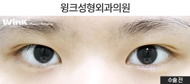 Let’s Learn About Before and After Natural Adhesion Double Eyelid Surgery image 2
