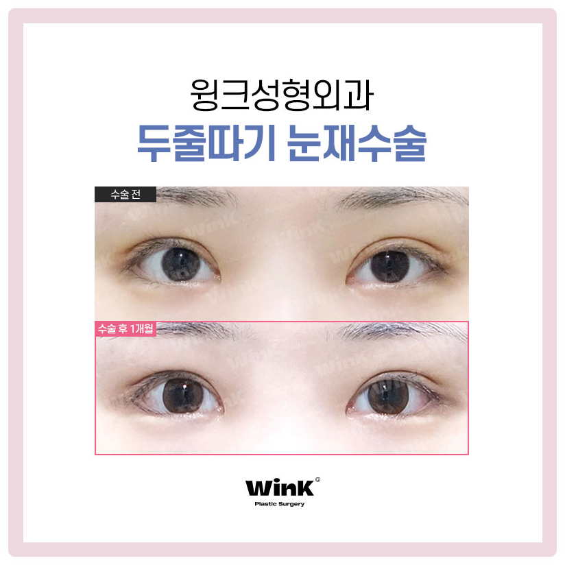 Revision Surgery for Sausage-Like Double Eyelids: Lowering the Double-Eyelid Line, Wink Plastic Surgery Sausage-Eye Revision Review image 9